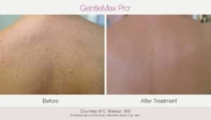 Laser Pigmentation Removal - Before & After Photos