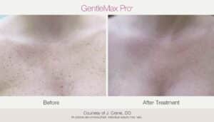 Laser Pigmentation Removal - Before & After Photos 1