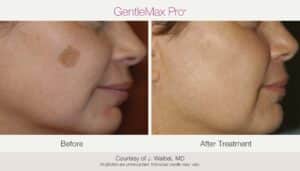 Laser Pigmentation Removal - Before & After Photos
