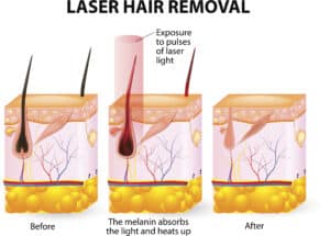 Laser Hair Reduction Graphic Showing Laser Heating Follicle and Follicle then Falling Out