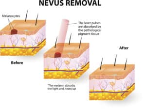 Graphic showing how laser pigmentation removal at our clinic in Portland, Oregon heats up and breaks apart pigment so it can be exfoliated over time.